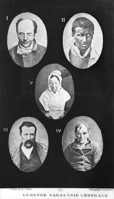 Demencia, Parálisis General, ilustración de Nouveau traité élémentaire et pratique des maladies mentales por Henri Dagonet (1823-1902) París, Baillière, 1876 de French Photographer